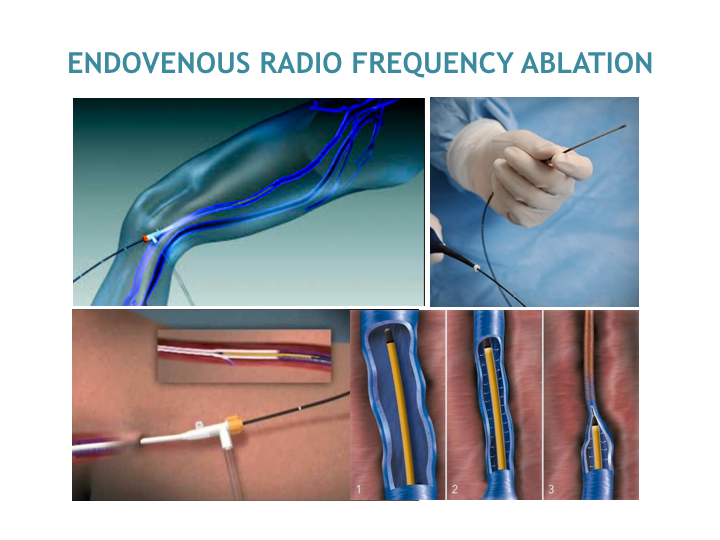 Venous Vein Ablation Affinity Heart Care